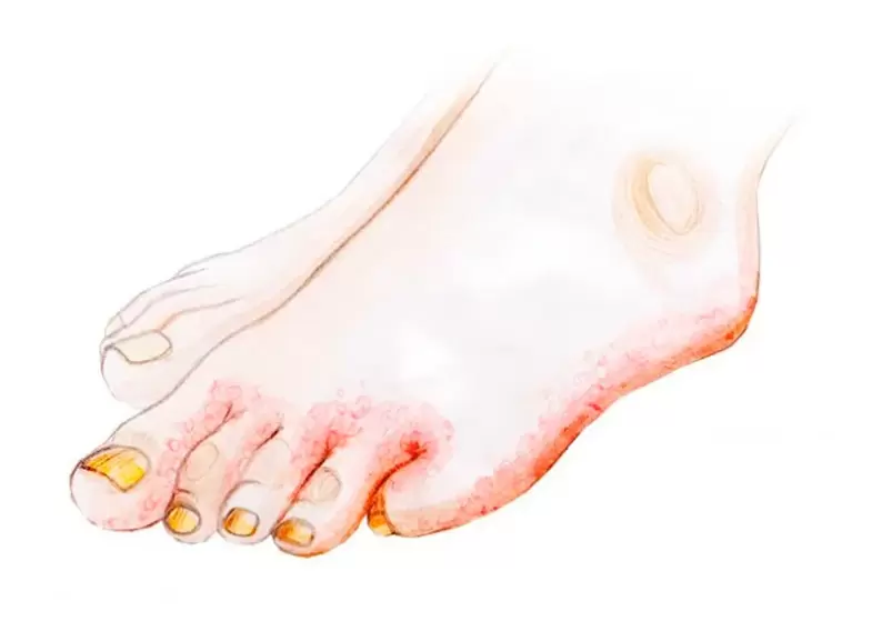 Гъбички по пръстите на краката и как се прилага крем Zenidol