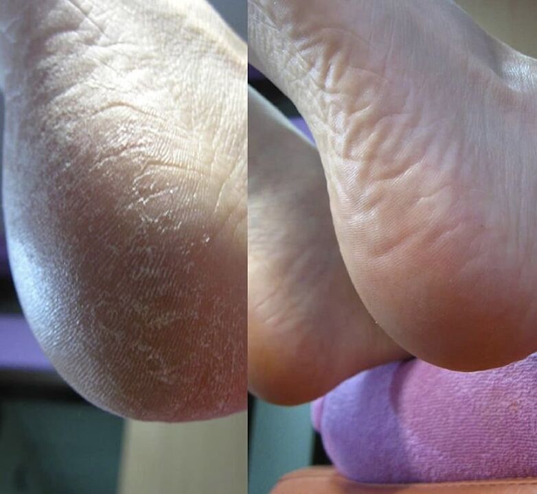 Снимка на петата на стъпалото преди и след използване на крем Zenidol