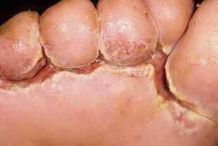 симптоми на гъбички на ноктите на краката