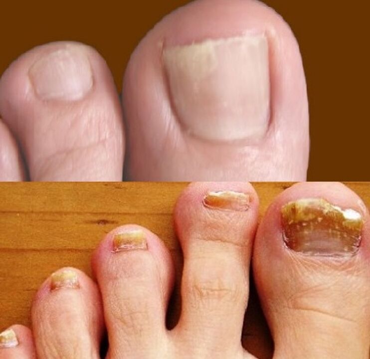 гъбички по ноктите на краката