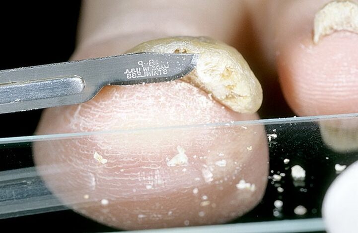 изстъргване на ноктите за диагностициране на гъбички