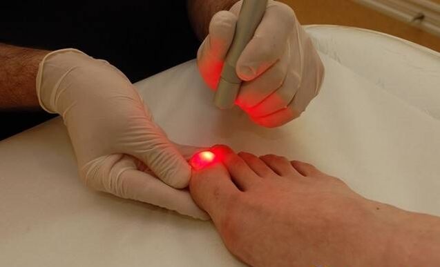 лазерно лечение на гъбички по ноктите на краката