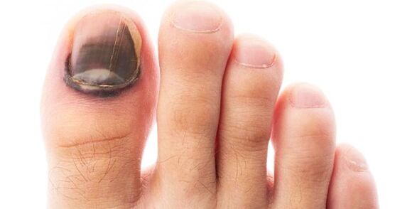 черен нокът като симптом на гъбички