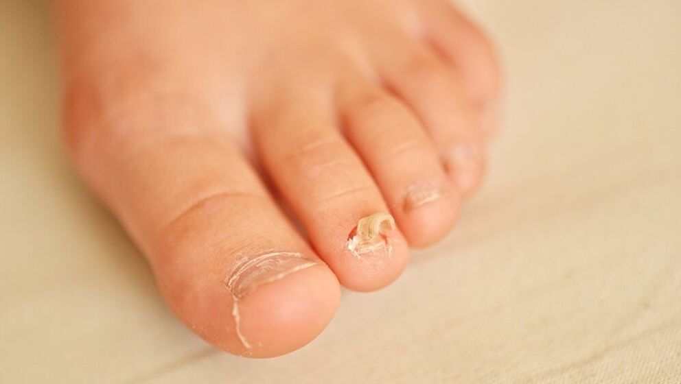 симптоми на гъбички по ноктите на краката