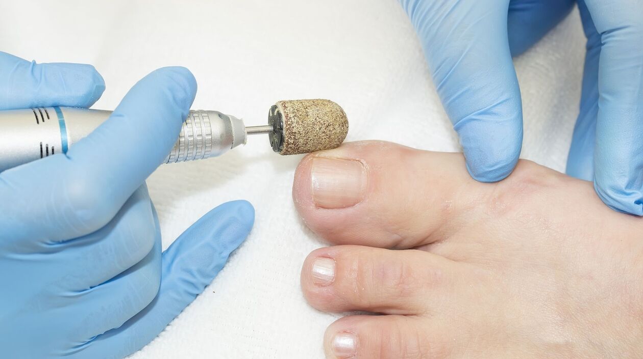 апаратно лечение на гъбички по ноктите на краката