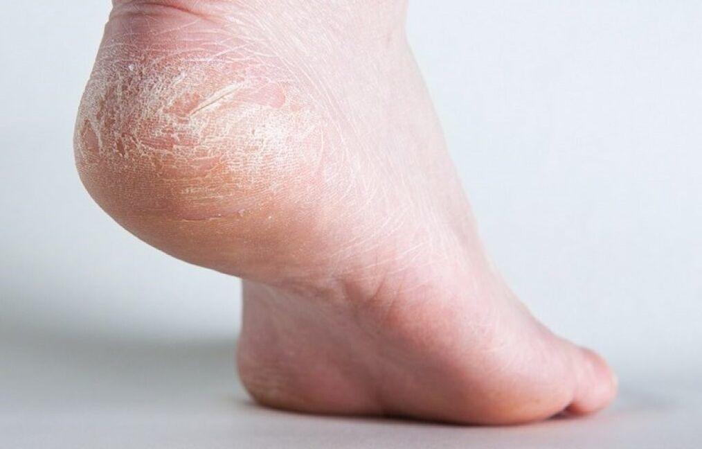 кожни гъбички на крака как да се лекува