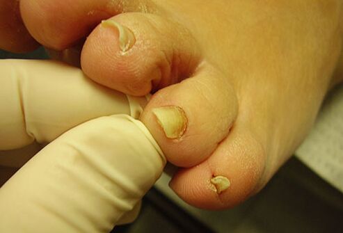жълти нокти на краката с гъбички