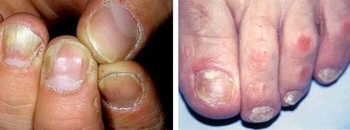 прояви на гъбична инфекция по ноктите