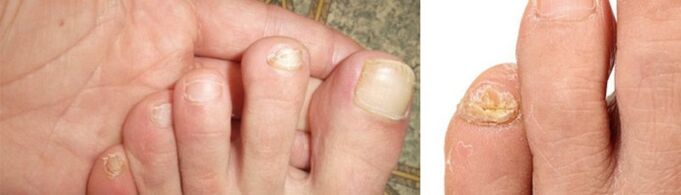 снимка на прояви на гъбички по ноктите на краката