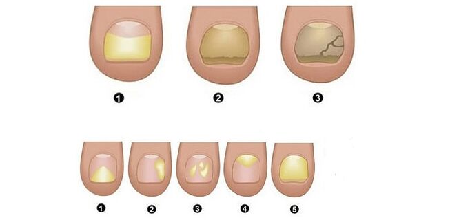 етапи и симптоми на гъбички на ноктите на краката