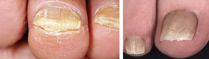 увреждане на ноктите с гъбична инфекция