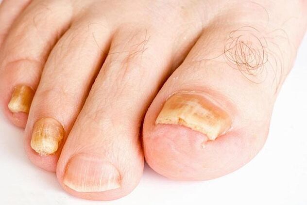 как изглежда гъбичките на ноктите на краката