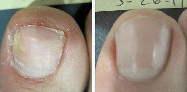 преди и след лечение на гъбички по ноктите