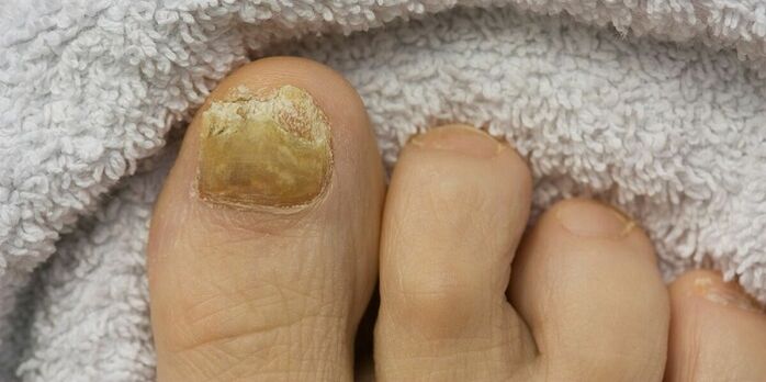жълт нокът на крака с гъбична инфекция