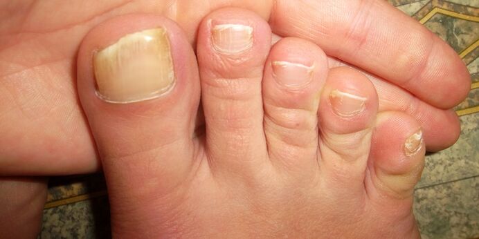 увреждане на ноктите на краката с гъбички