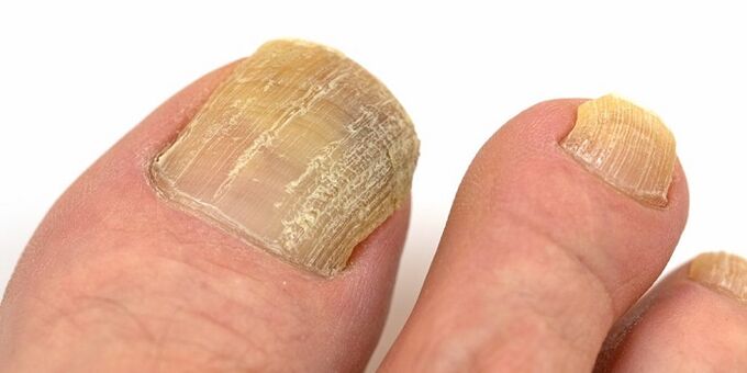 увреждане на ноктите с напреднала гъбична инфекция
