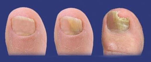 етапи на развитие на гъбичките по ноктите на краката