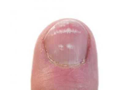 началният стадий на инфекция с гъбички по ноктите